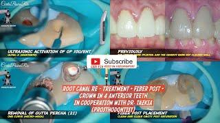 ROOT CANAL RE TREATMENT + FIBER POST + CROWN IN 4 ANTERIOR TEETH, CLINICAL CASE DENTAL CASE REPORT️