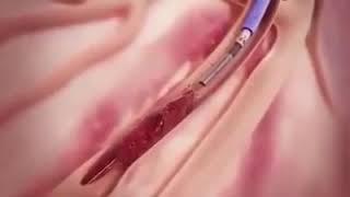 Catheterization |Coronary artery angioplasty |Angioplasty|Medicos study corner |MBM