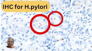 Unusual bacillary and coccoid forms of Helicobacter pylori.