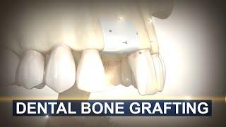 Bone Grafting for Dental Implants in 3D Animation | Maxillofacial & Dental Implant Surgery