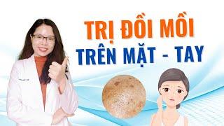 Cách trị đồi mồi trên mặt - tay từ Bác sĩ da liễu - Bác sĩ Nguyên