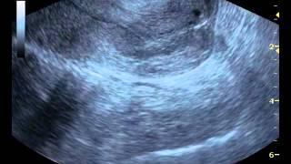 Skuamöz Hücreli Serviks Kanseri Ultrasound 1;1