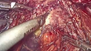 Low Bowel Resection With Endometriosis excision