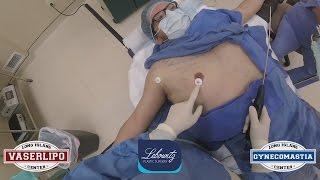 New STEALTH Hi-Def VaserLipo Gynecomastia Surgery by Dr. Lebowitz in Huntington Long Island NY