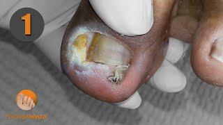 Ingrown toenail & granuloma (1st part) [Podología Integral]