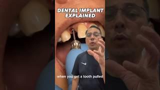 Upper Anterior Dental Implant Placement Procedure | In Office to Hands On Dental Training #shorts