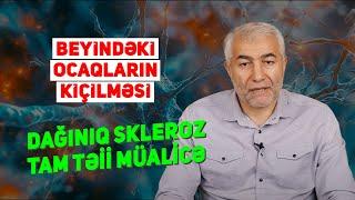 Dağınıq skleroz tam təbii mülicə - Beyindəki ocaqların kiçilməsi | Fizuli Hüseynov