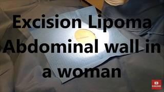 Lipoma Removal 2