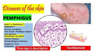 Pemphigus Vulgaris |Pathogenesis, clinical features, oral manifestations | Pemphigus Variants PART 1