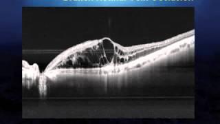 Topcon DRI OCT-1, Deep Range Imaging Optical Coherence Tomography