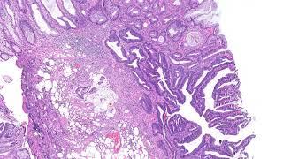 SSA with dysplasia and invasive adenocarcinoma (pT1)