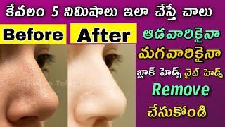 Black heads white heads removal at home in telugu|Amazon skin care