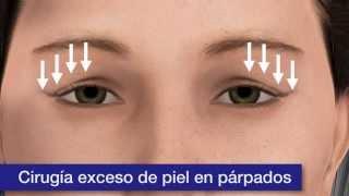 Operación de párpados | Clínica Baviera