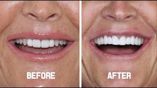 Zirconium Crowns ( Hollywood Smile) - Joanne from England