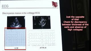 AMILOIDOSI CARDIACA  (ESSENTIALS OF CARDIAC AMYLOIDOSIS)