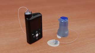 Inserting the Medtronic Extended™ infusion set