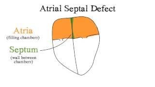 Atrial Septal Defect (ASD)