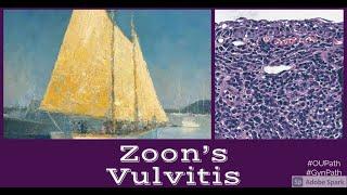 Plasma Cell Vulvitis Zoon's