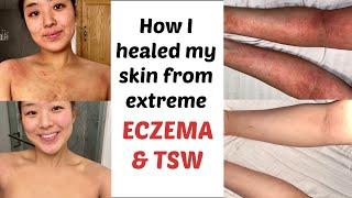 Top 7 things to heal from eczema and TSW - my skin healing journey