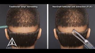 NeoGraft hair transplant procedure - animation