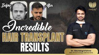 Incredible Hair Transplant Results | Medlinks