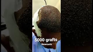 5000 Grafts Hair Transplant