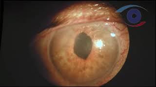 Факоэмульсификация осложненной катаракты при полном иридокорнеальном контакте