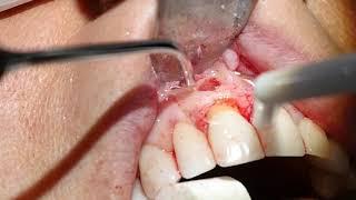 Laser apicectomy by Dr Joseph Sarkissian