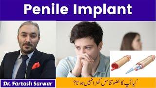 Penile Implant Benefits | Penile Implant Surgery | Dr. Fartash Sarwar | Best Urologist | Urdu/Hindi