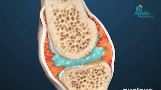 Rheumatoid Arthritis Treatment