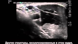 Под узи навигацией. Аксиллярная блокада под узи. Под узи навигацией. Под узи навигацией. Седалищный нерв под узи.