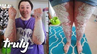 My Body Is 90% Covered In Psoriasis | TRULY