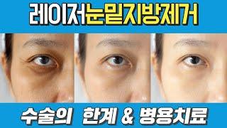 레이저 눈밑지방제거 한계와 병용치료 해결 방법을 강남테마피부과에서 소개합니다.