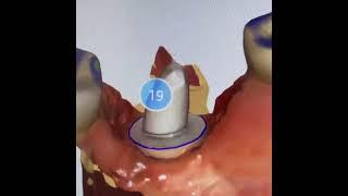 Surgical placement and restoration of a tissue level Zsystems zirconia implant