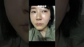레디어스 시술기 2주차 (feat.wife) 생생한 신상 콜라겐필러로 볼륨up!!!#레디어스시술기#레디어스#콜라겐필러