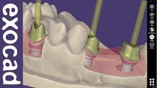 exocad Video Tutorial (basic): Custom Abutment Design