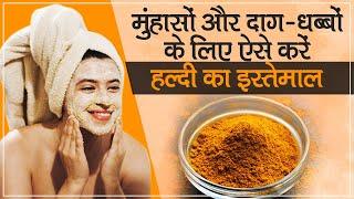 Turmeric For Acne: Use turmeric like this for acne and blemishes