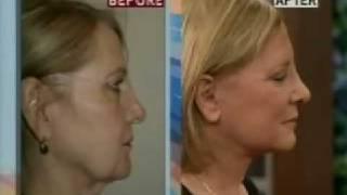 Facelift By Facial Plastic Surgeon Dr. Sam Rizk