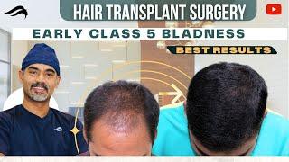 Hair Transplant In Bangalore | Best Surgeon Cost &  Results  Of Hair Transplant In Bangalore