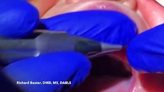 CO2 Laser Tongue and Lip Tie  Release in a Baby