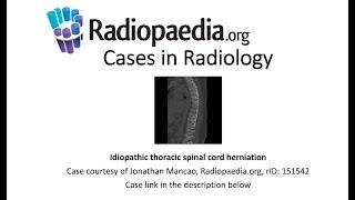 Idiopathic thoracic spinal cord herniation (Radiopaedia.org) Cases in Radiology