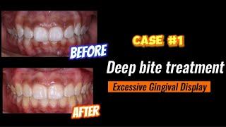 Deep bite treatment | Excessive Gingival