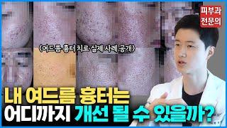 수많은 치료를 받아도 내 여드름 흉터가 낫지 않는 이유 / 여드름 흉터 치료의 본질을 알려드립니다