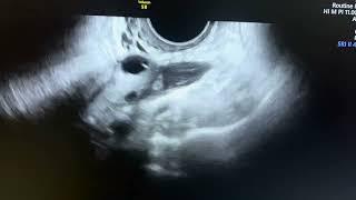 ULTRASOUND OF PYOSALPINX