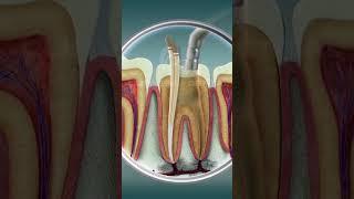 Root Canal Treatment | Curveia Dental I RCT