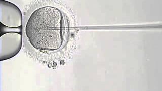 Intracytoplasmic Sperm Injection Procedure (ICSI)