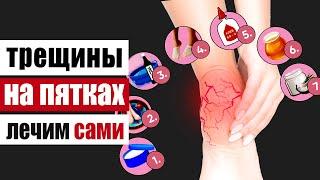 Трещины на пятках – что они скрывают и что делать в домашних условиях