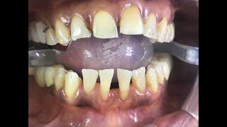 Teeth Veneer | 55 Year Old Female | For Closing Lower Anterior Teeth Gap | Anand