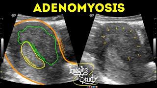 Adenomyosis || Ultrasound || Case 42