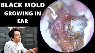 Black Mold Growing In Ear Canal (Aspergillus Niger Fungus Extraction)